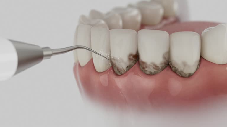 Trusted Dental Veneers service in Parker, FL - Dentist Open Now